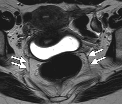 mri with contrast for endometriosis